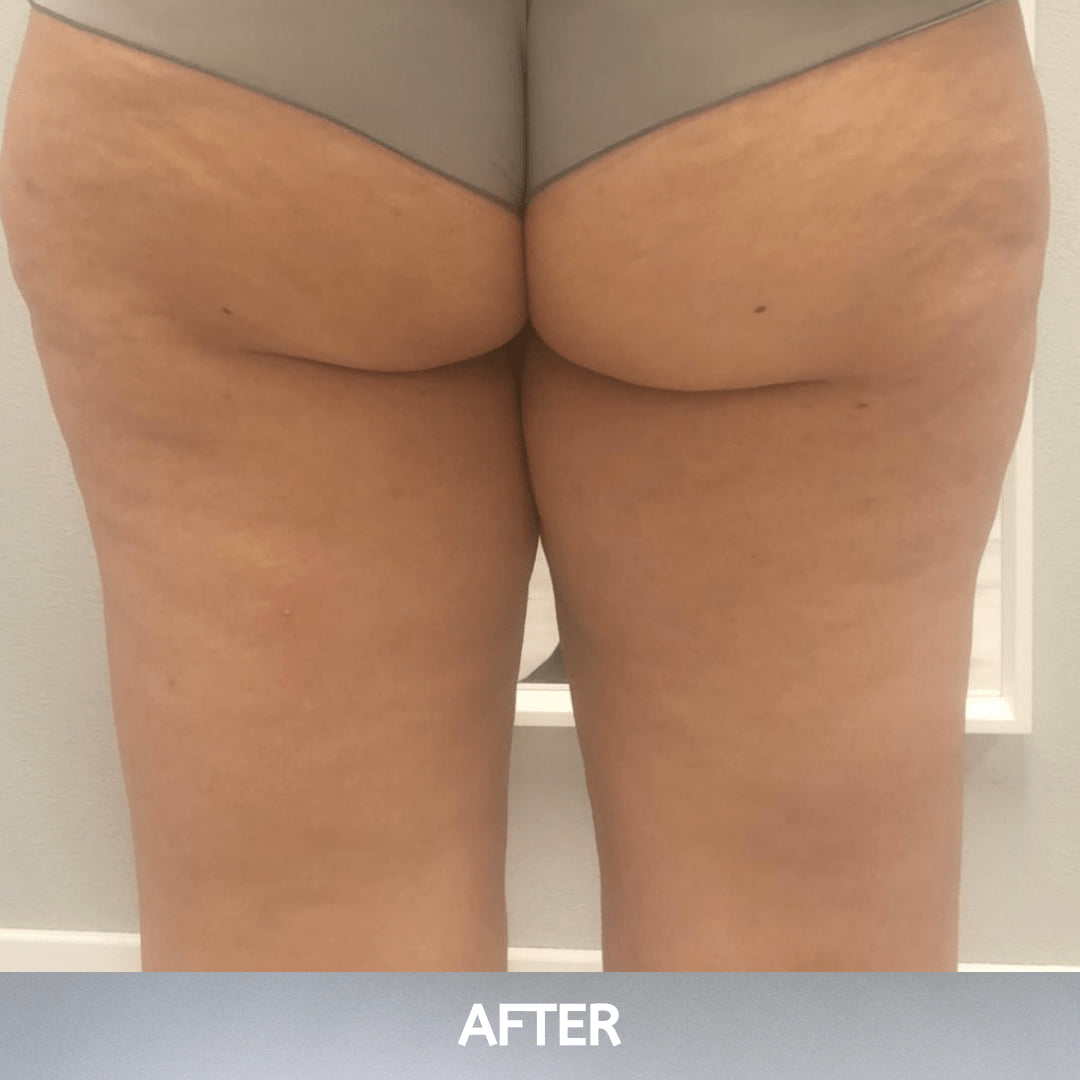 After cellulite